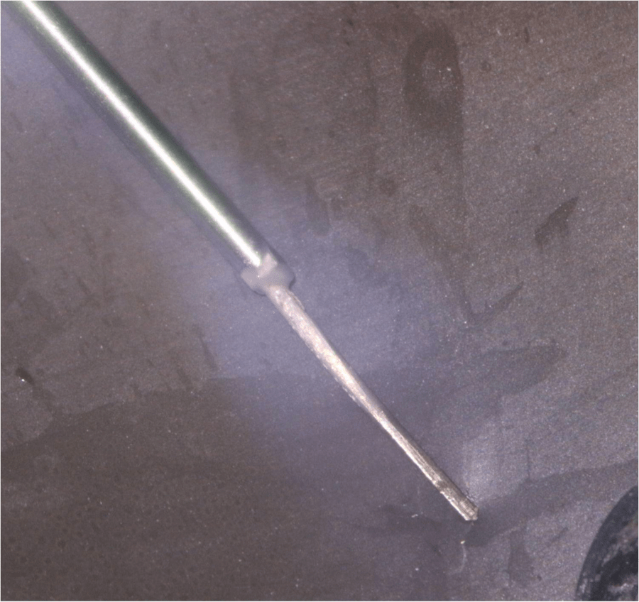 Case Report of a Silver Point Removal TriCity DevTriCity Dev