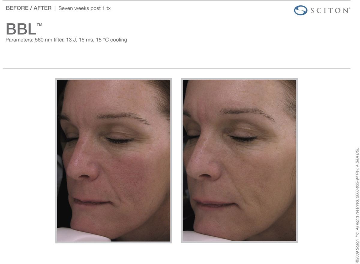 BroadBand Light (BBL) Tribeca Skin Center
