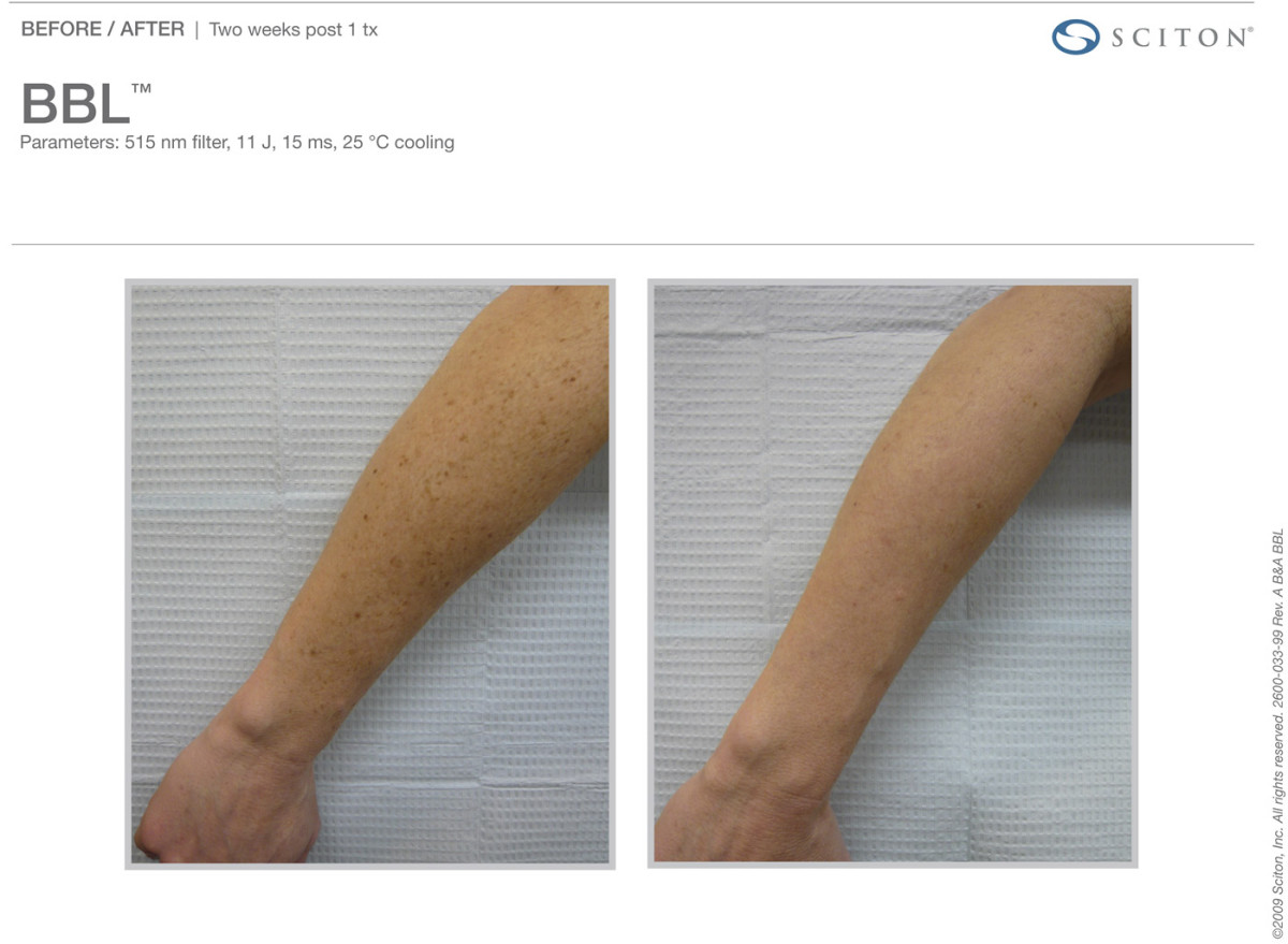 BroadBand Light (BBL) Tribeca Skin Center