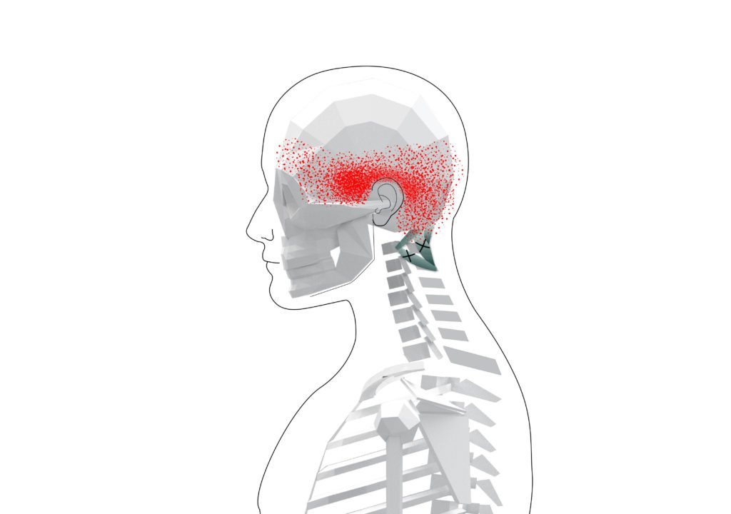 Suboccipitals Trigger Points (Overview and Tips for Self Treatment)