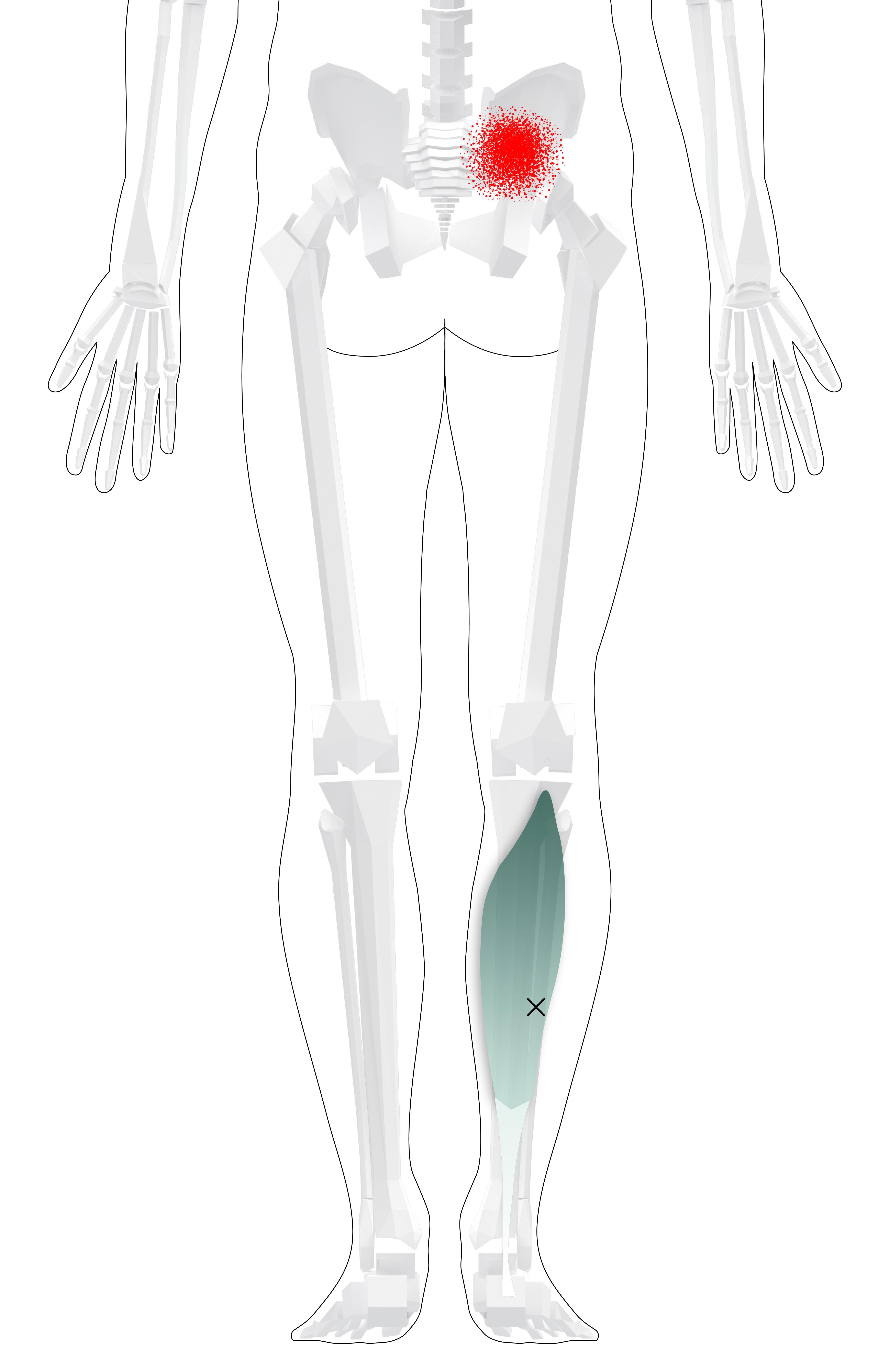 Soleus Trigger Points (Overview and Smart Tips for Self Treatment)