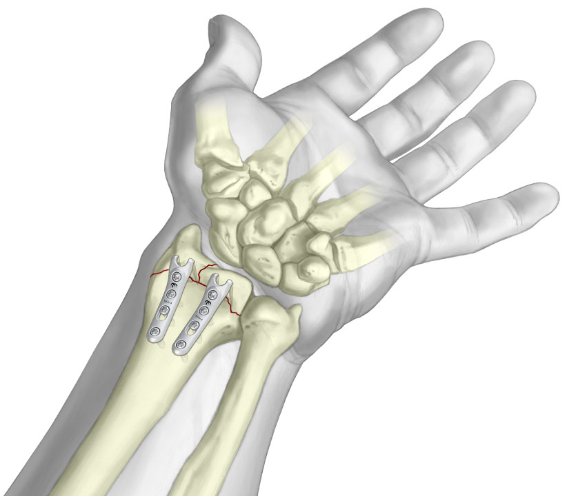 Volar Hook Plate Wrist Fracture Fixation Plate TriMed Inc.