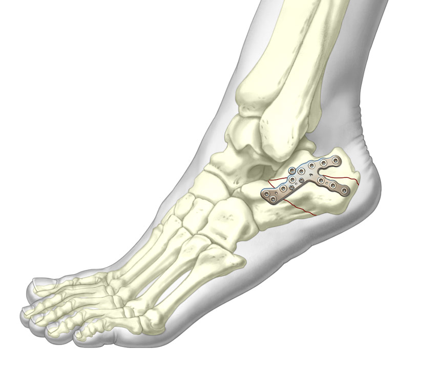 Sinus Tarsi Plate Lower Extremity Fixation TriMed Inc.