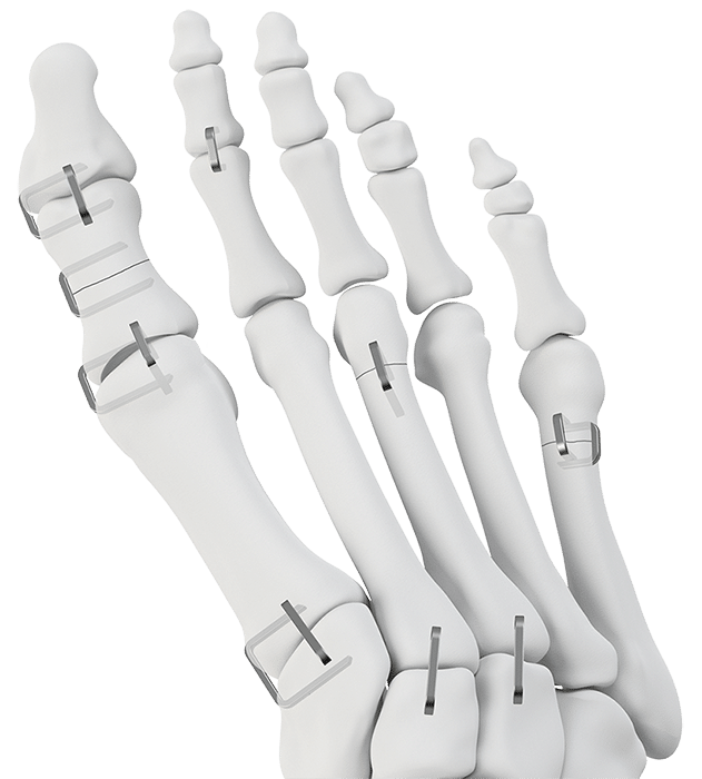 Upper & Lower Extremity Orthopedic Implants TriMed