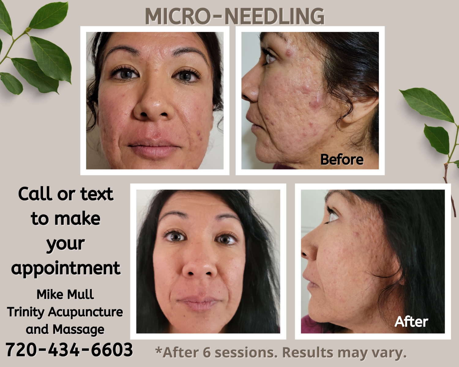 Microneedling » Trinity Mobile Massage and Acupuncture Acupuncture