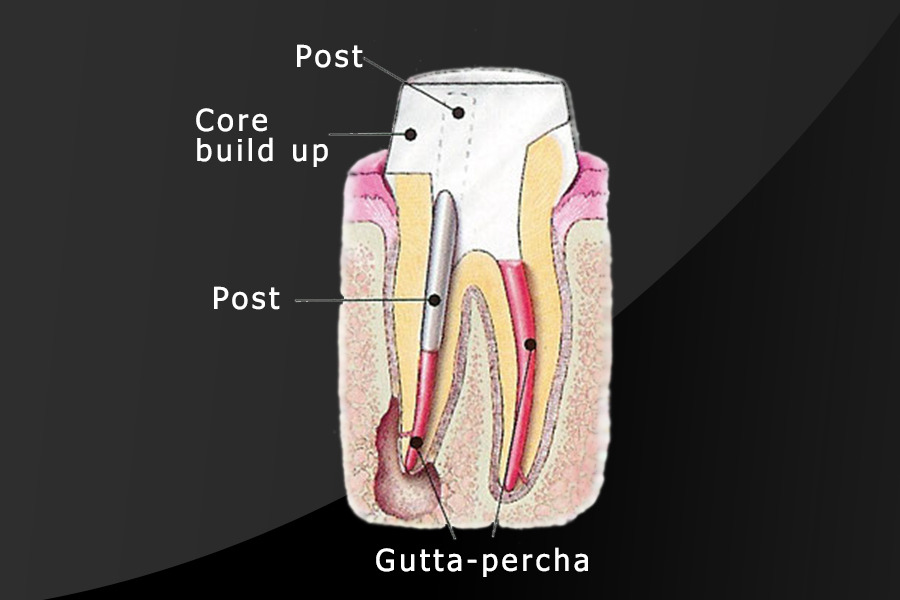 Post and Core Dental Treatment Tru Dental Charlotte