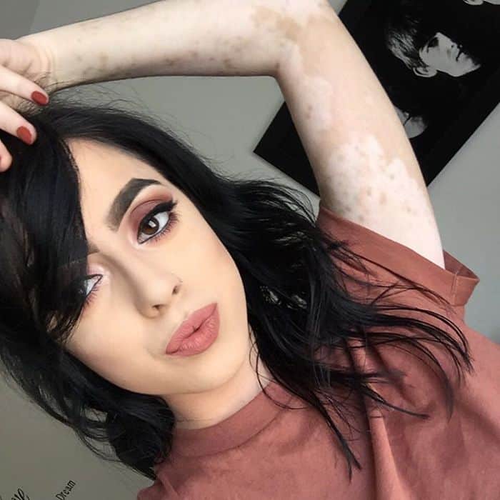Woman Once Bullied For Vitiligo Now Uses The Unique Markings To Create
