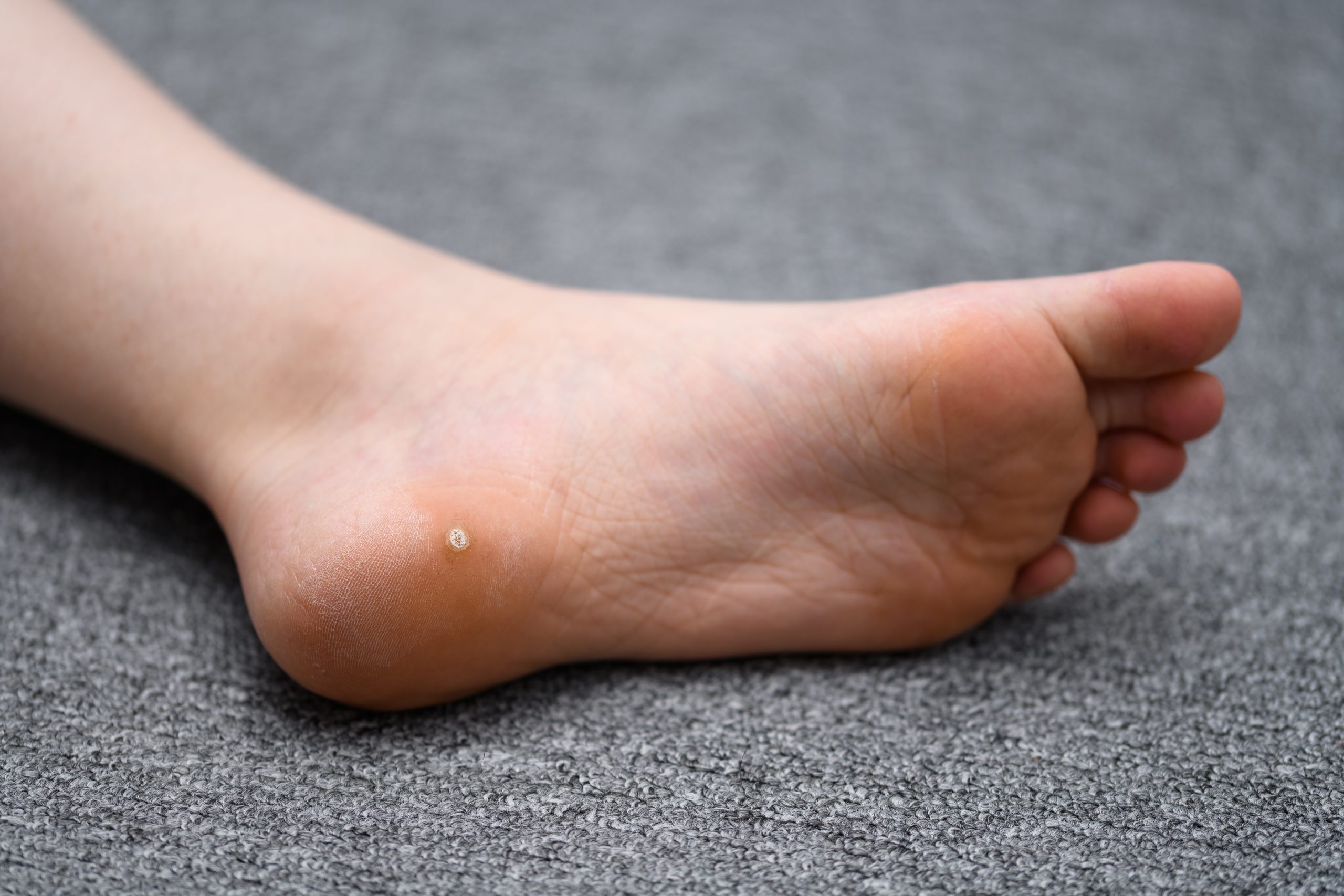 What’s the Deal with Warts? Twin Rivers Health Care