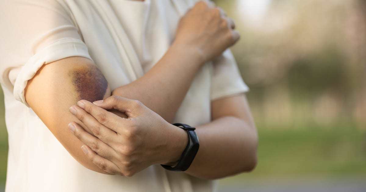 TrustCare Contusions Overview, Types, and Treatment