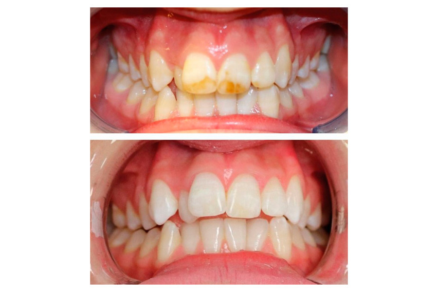Understanding Enamel Hypoplasia, Causes & Treatment