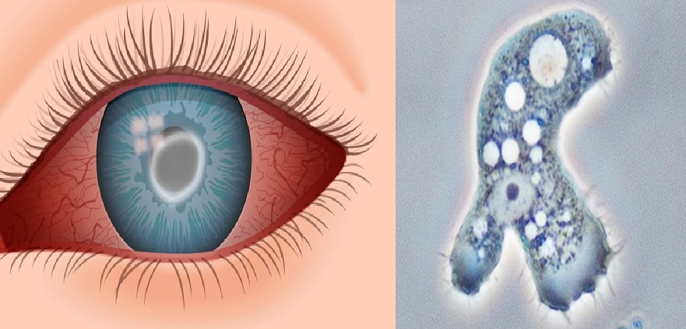 Lentilles de contact sous la douche : un britannique devient borgne