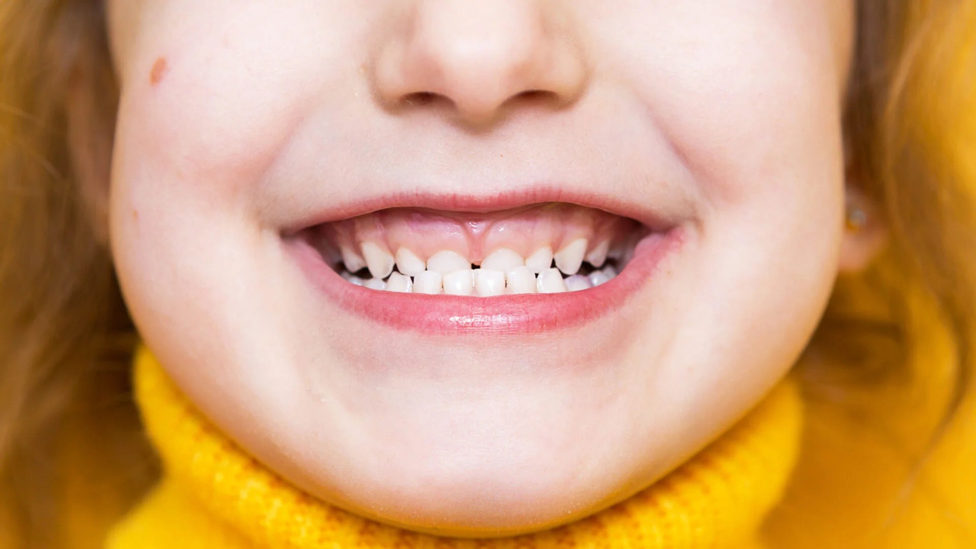 Understanding Underbites in Toddlers autobrush®