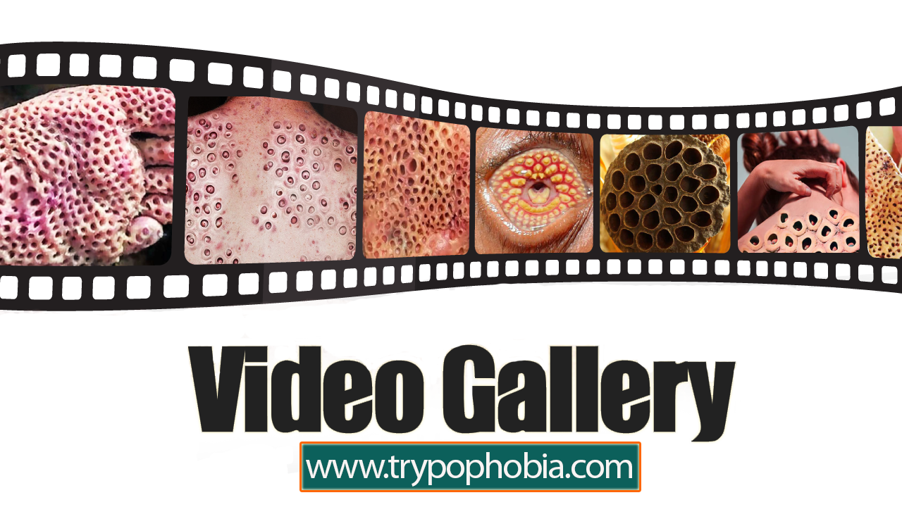What is Trypophobia? Find out if you have a fear of holes Trypophobia