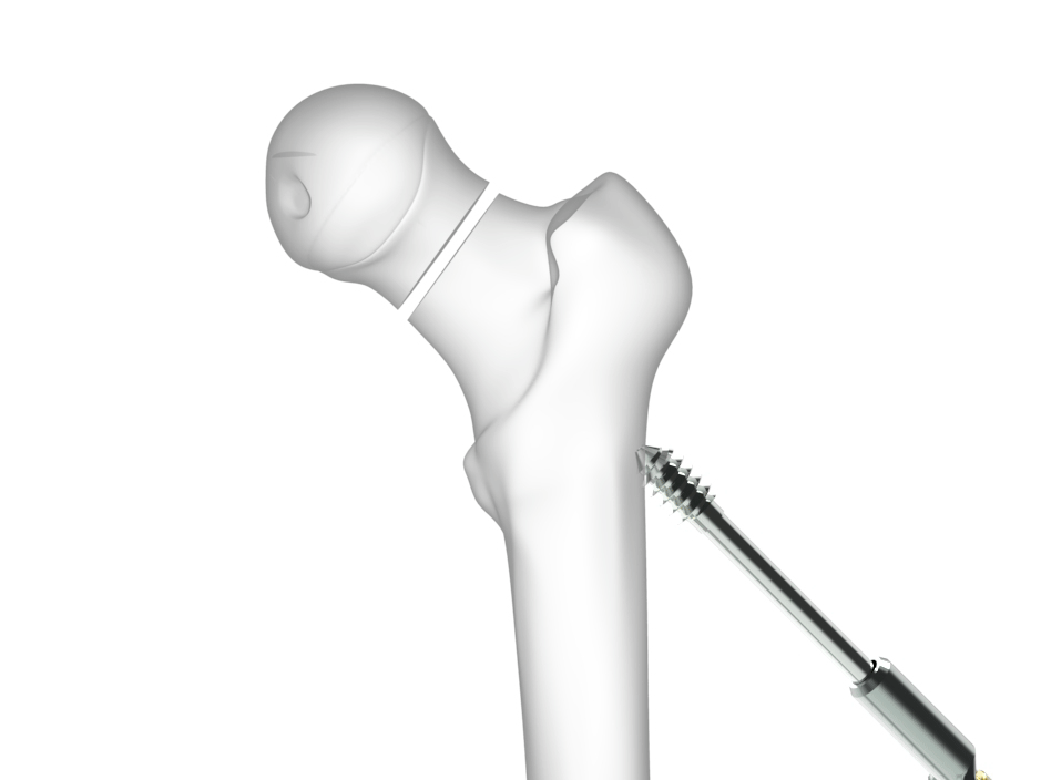 Placas DHS (Dynamic Hip Screw tornillo dinámico de cadera) TST