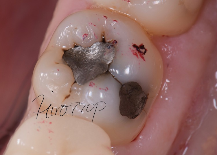 アマルガム充填物を除去してダイレクトボンディング治療を行ったケース｜神谷町駅すぐの歯医者 虎ノ門デンタルプラクティス【むし歯治療（メタル除去