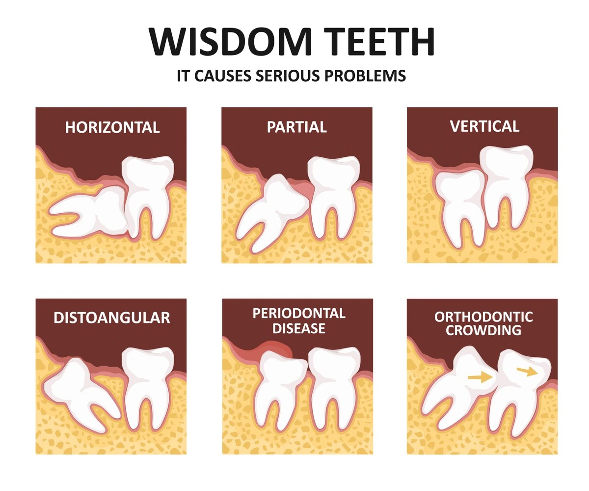 8 Warning Signs for Impacted Wisdom Teeth & 4 Impaction Type