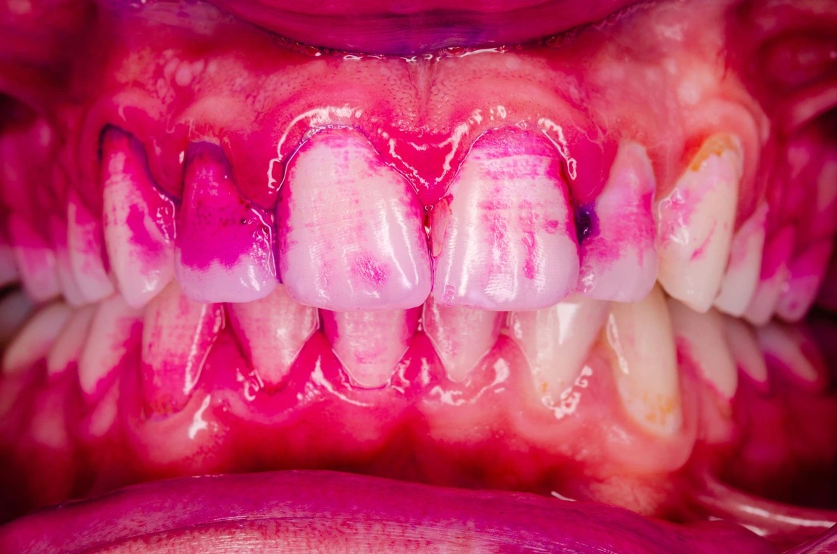 What Are Plaque Disclosing Tablets & How To Use Them