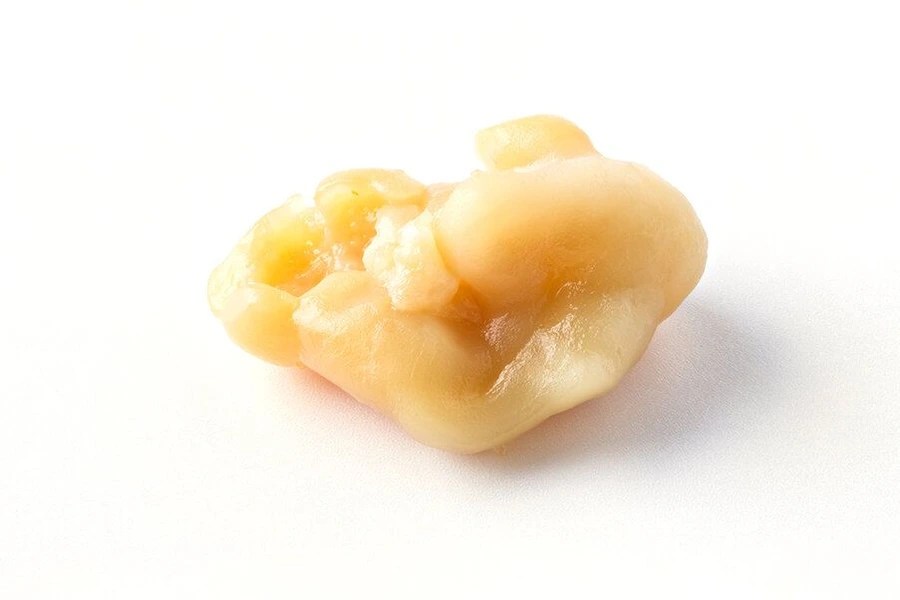 What Causes Tonsil Stones Symptoms & Removal