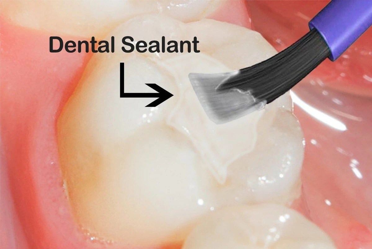 Dental Sealants Do You Need Them & Are They Safe?