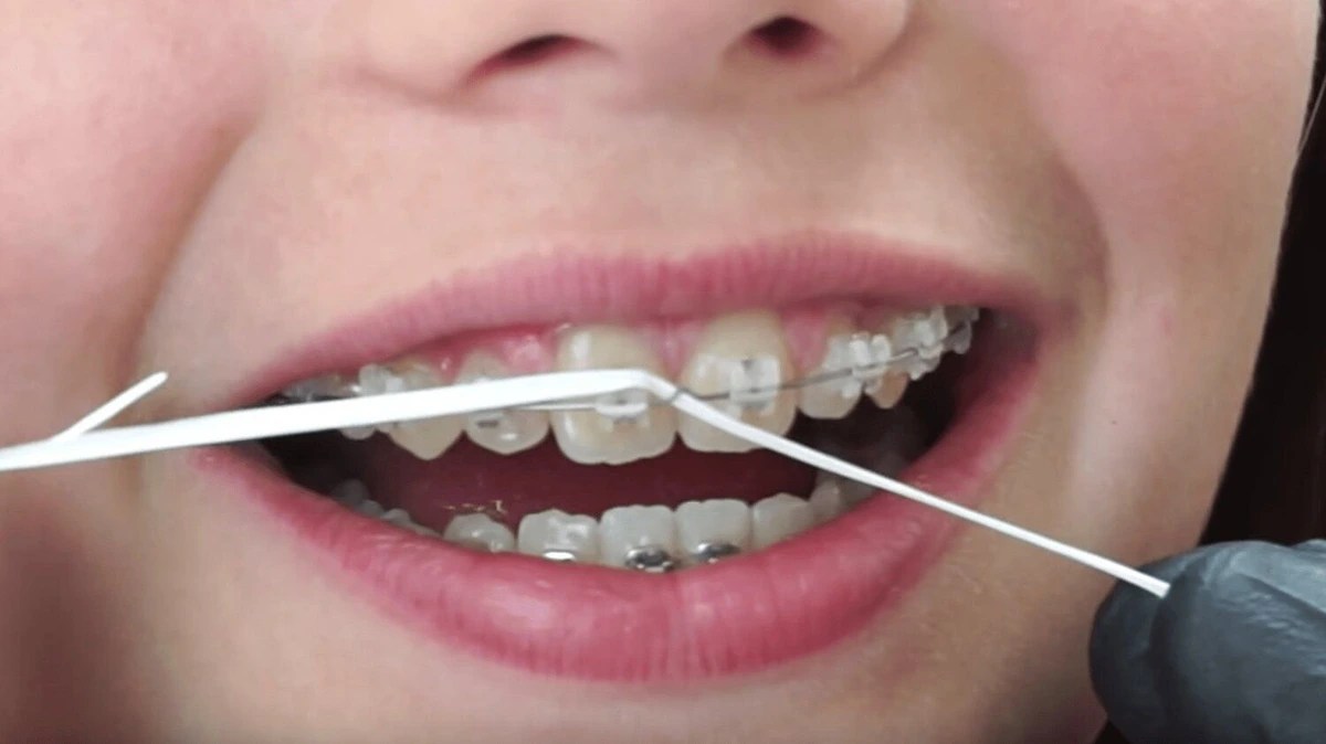 How To Take Care Of Braces Water Flosser, Brushing, & More