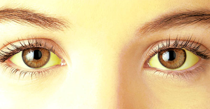 Ictericia Síntomas, causas y tratamiento.