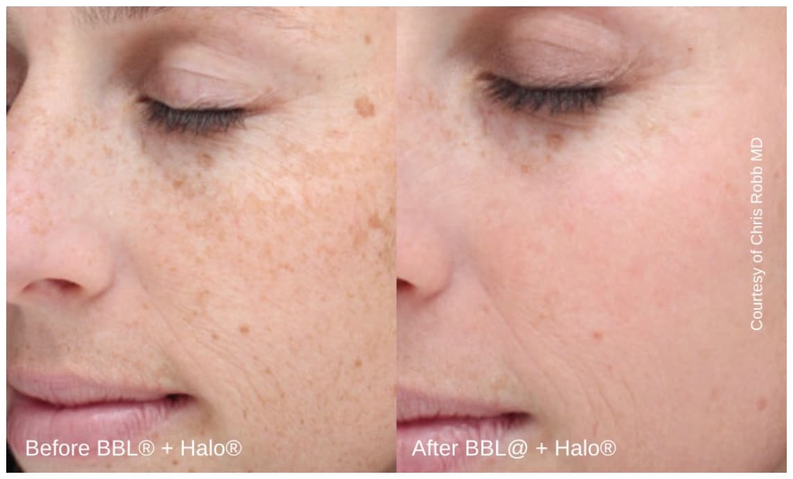 Laser Skin Rejuvenation in Livingston, NJ