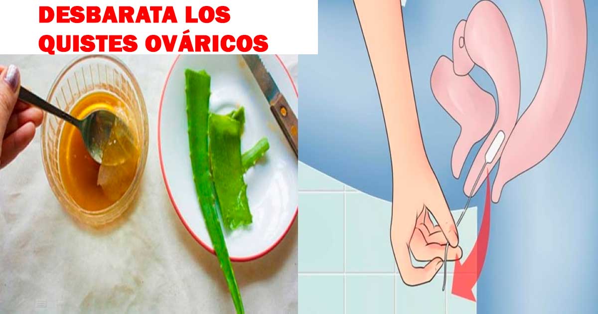 Aplica este antiguo remedio natural para desbaratar los quistes y