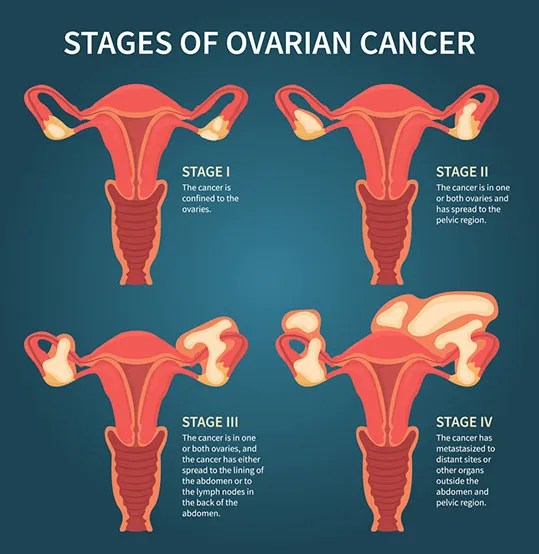 Take Ovarian Cancer Seriously Risks, Diagnosis, & Treatment The Woman's Clinic