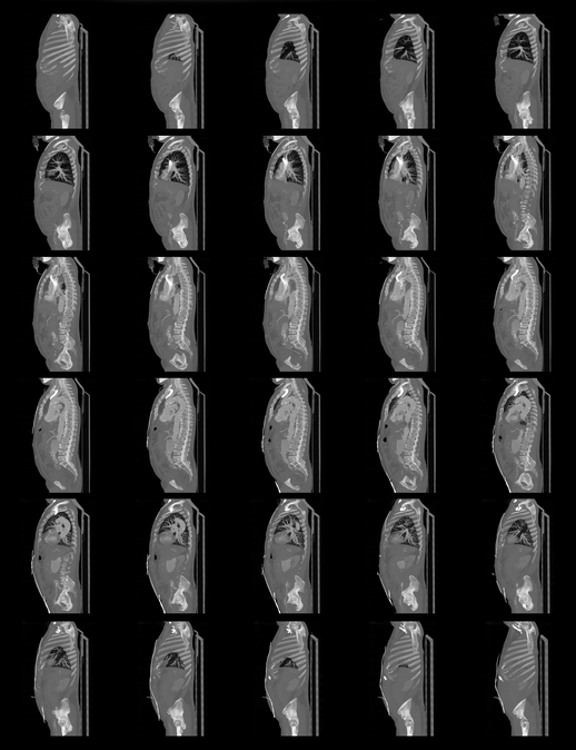 What is a Full Body CT scan? Two Views