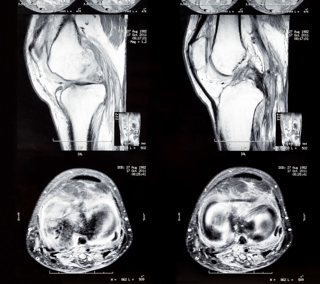 What is a Knee CT scan? Two Views