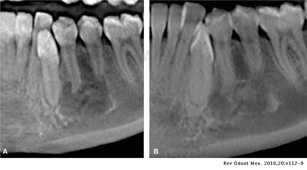الكيس العظمي وحيد البؤرة Solitary bone cyst موقع فكين