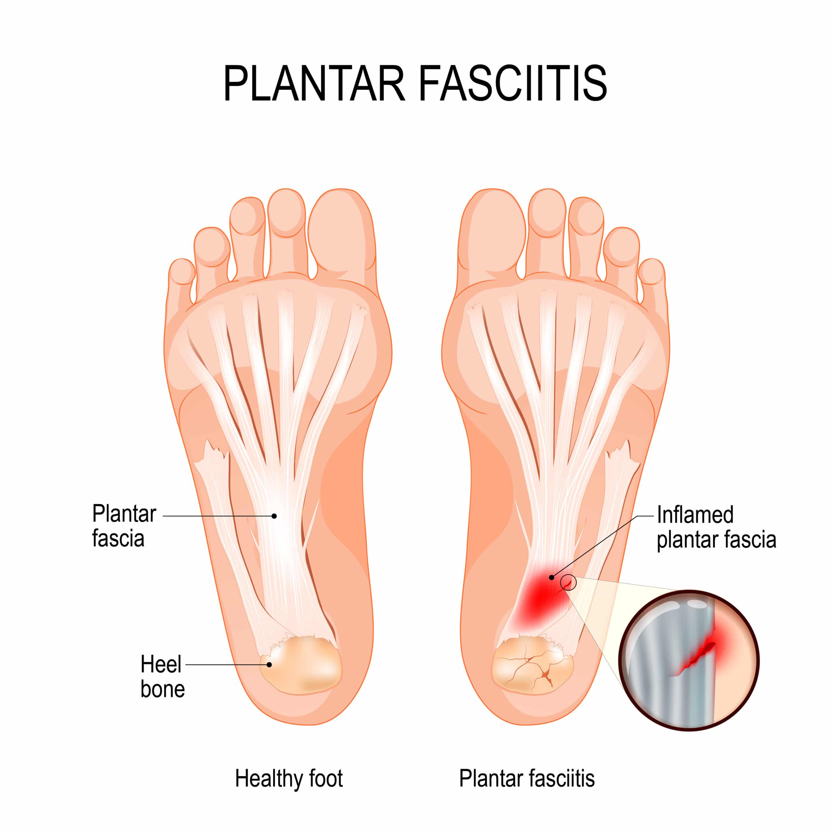 Plantar Fasciitis // Texas Foot and Ankle Center