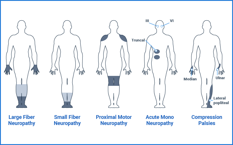 Peripheral Neuropathies Tyrrell Physiotherapy