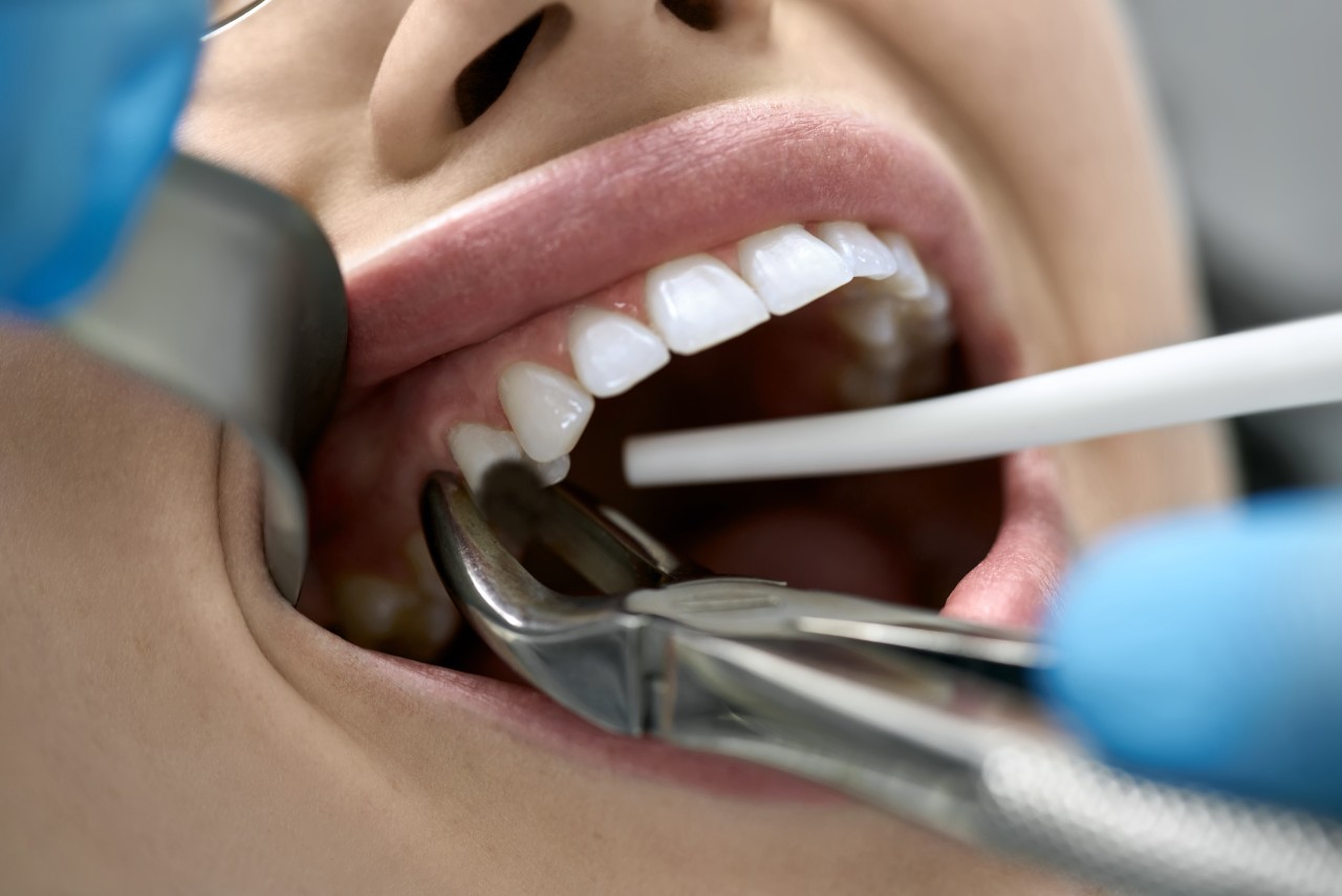 How Can I Fixed a Chipped Tooth? Tysons Dental Spa