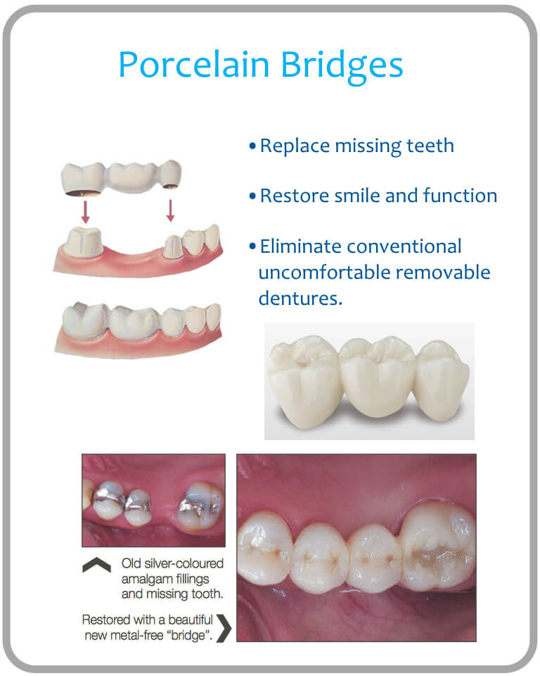Crown and Bridges UDental Clinic