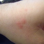 Bed Bug Bites Bed Bugs
