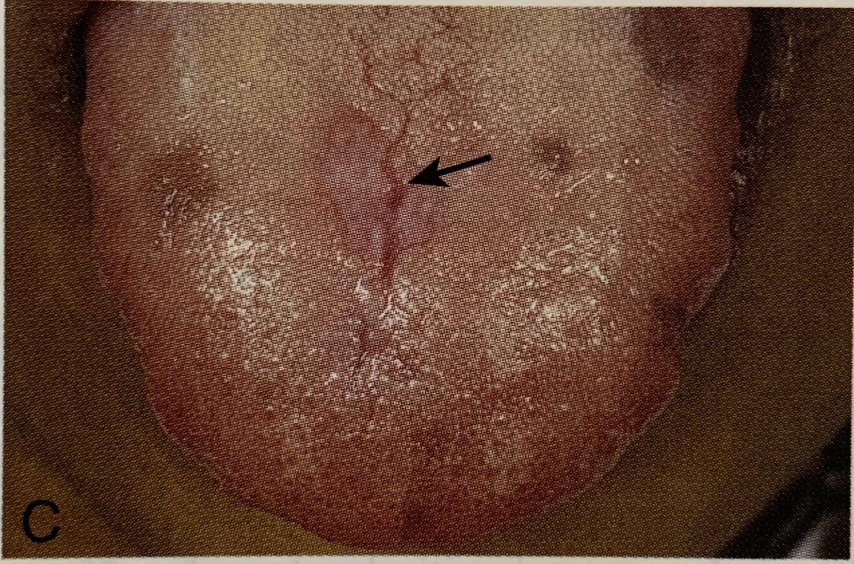 Pathophysiology Iron Deficiency Anemia