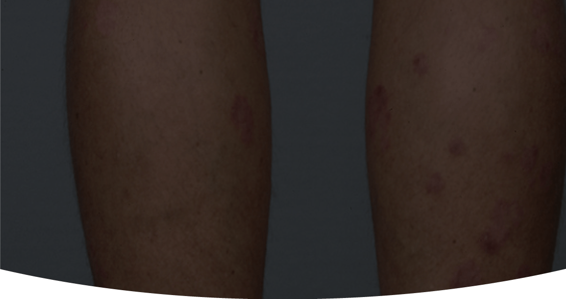 Ubet Could You Have Psoriasis