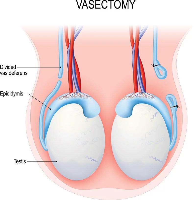 Vasectomy vs. tubal ligation Understanding the options UCHealth Today