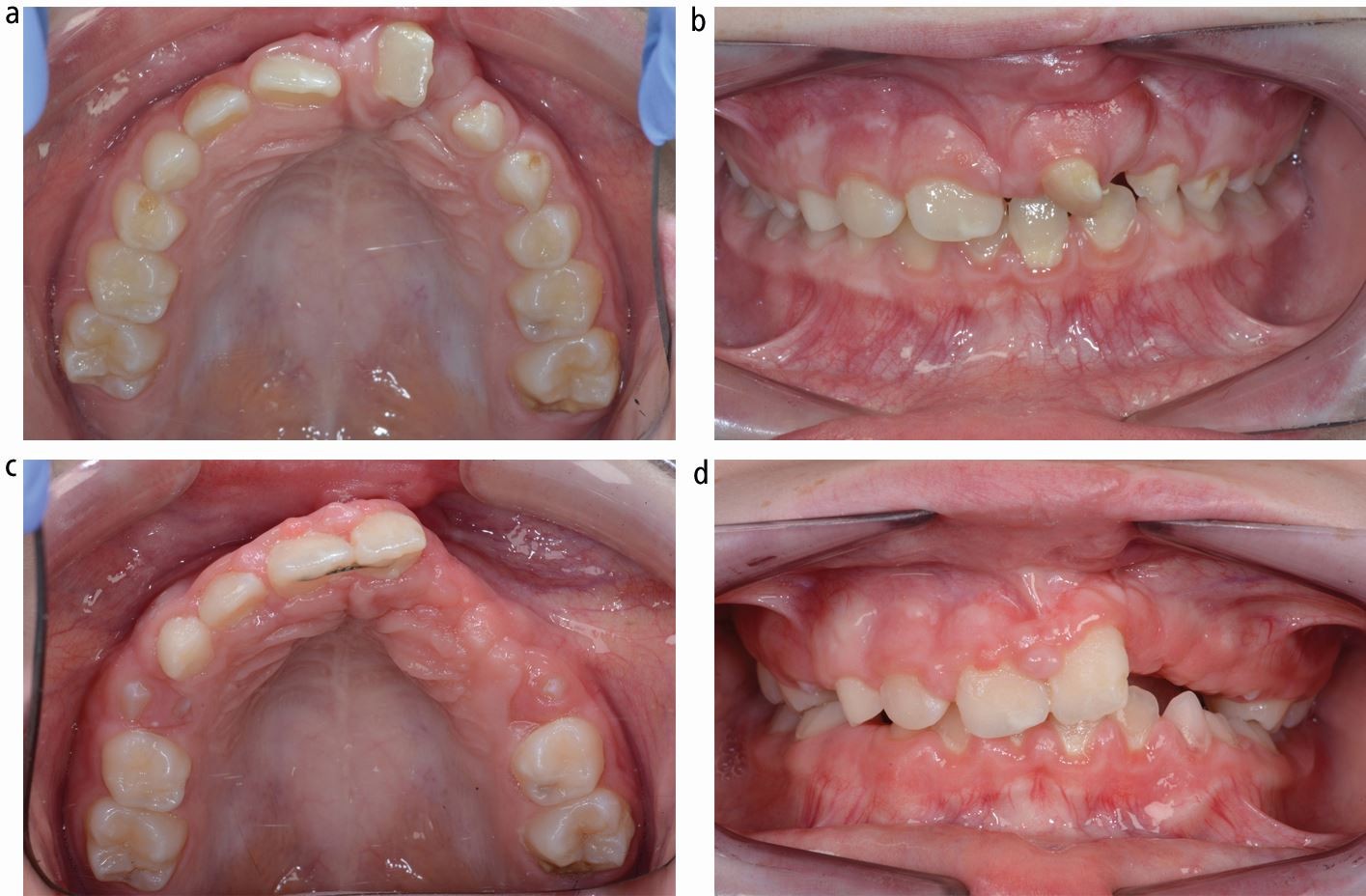 Orthodontic Treatment in Cleft Lip and Palate Patients UCO Magazines