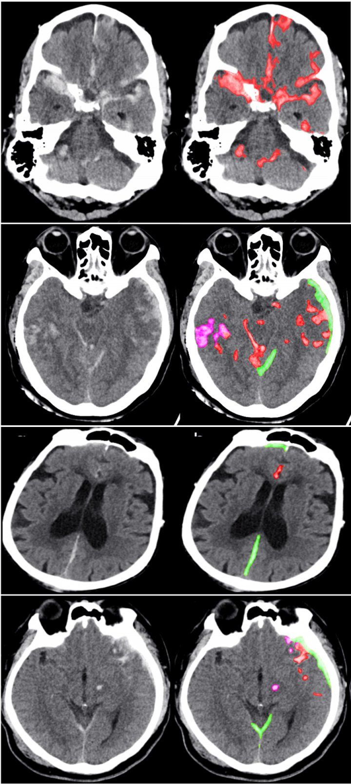 AI Rivals Expert Radiologists at Detecting Brain