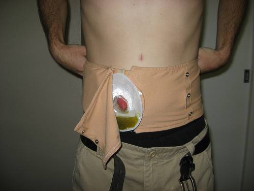 Photos 2 Ileostomy « UC to JPouch Story