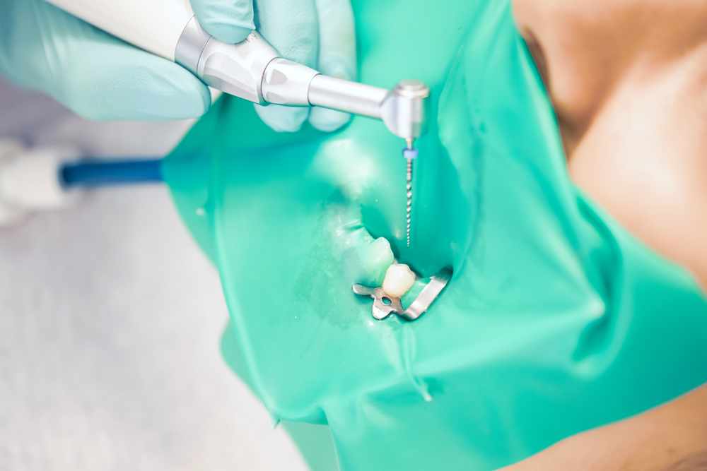 How Root Canal Treatment Can Treat an Infected Tooth? UDENZ MENA