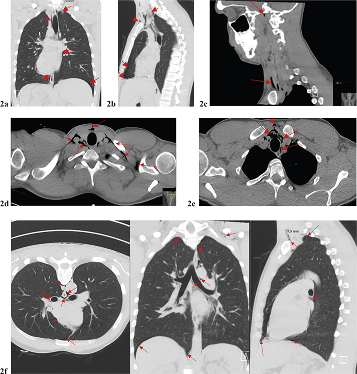 Recreational use of nitrous oxide causes seizure, pneumothorax, pneumomediastinum, and