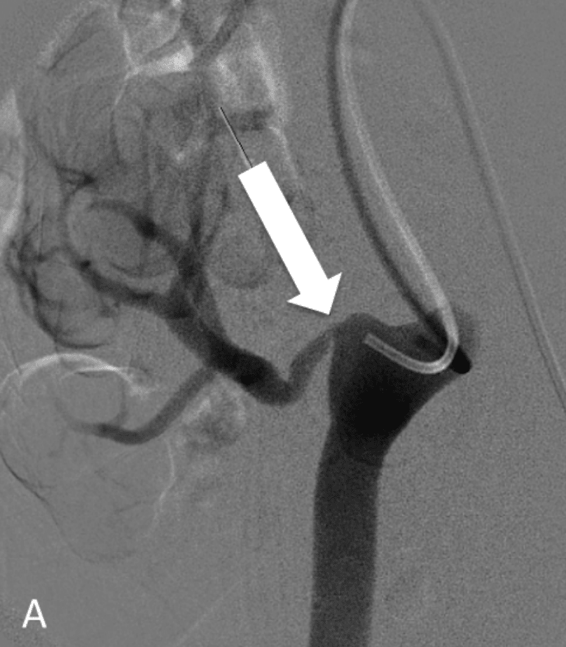 Renal Artery Stenosis Surgery