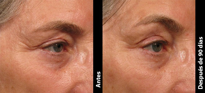 Antes & Después Lifting para Cejas, Cuello, Escote & Mentón Ultherapy