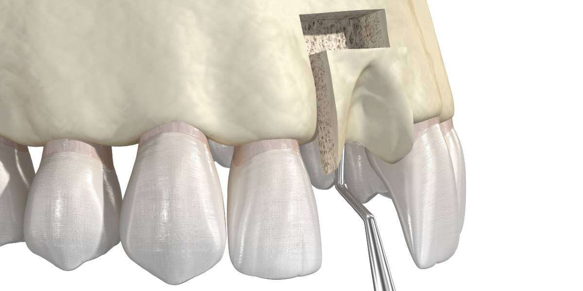 The Comprehensive Guide to Dental Bone Grafts