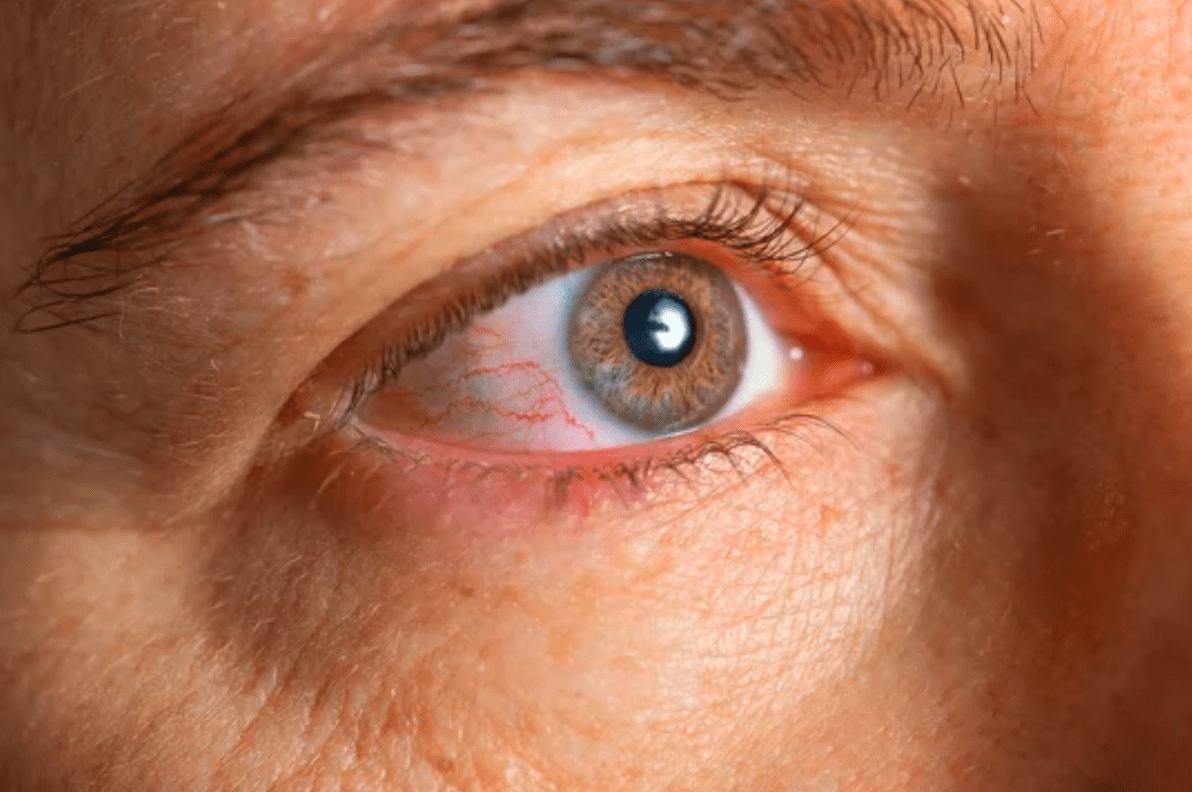 pinkeye Umedoc Telehealth Platform