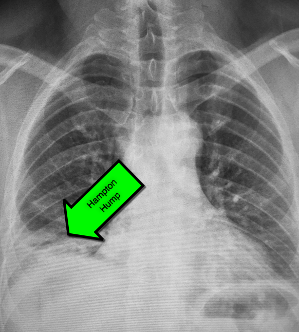 How to detect a pulmonary embolus on Xray Emergency Medicine Kenya