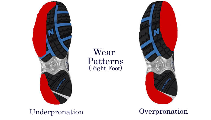 Underpronation Foot Supination